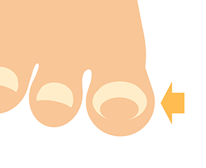 巻き爪のイメージ